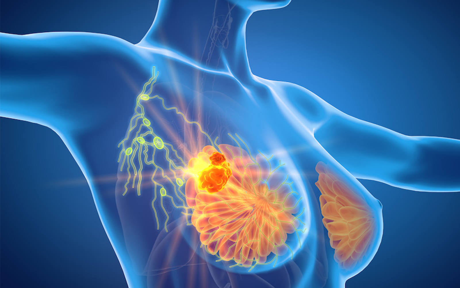 New Genomic Discovery Could Prevent Breast Cancer Drug Resistance