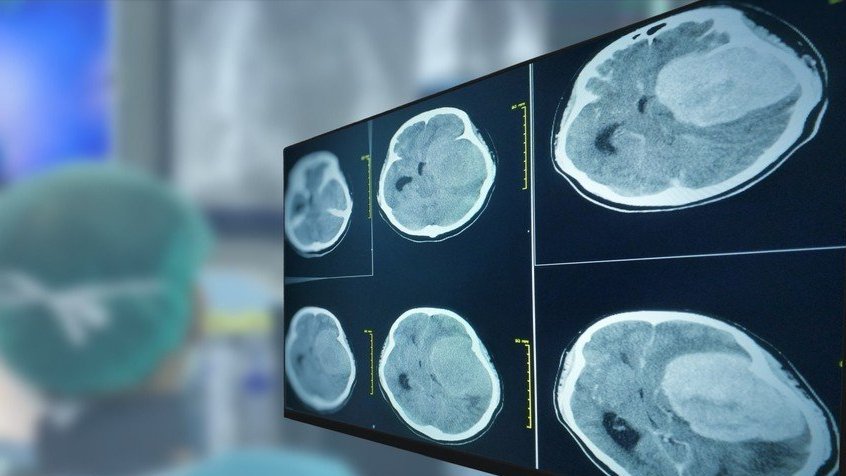 A CT brain scan showing a brain tumor on a computer monitor